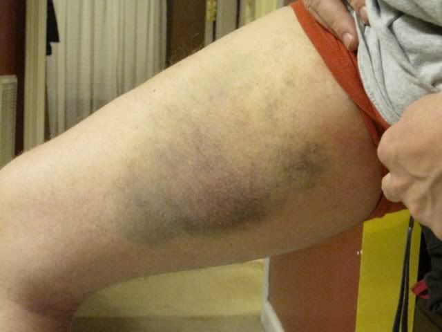 Bruise.jpg